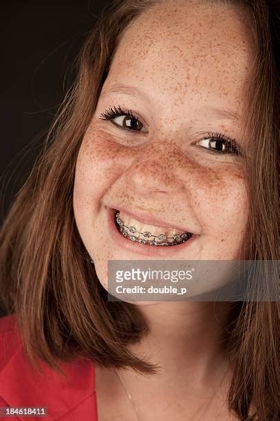 freckles and braces|Freckles Braces Stock Photos, Images & Pictures .